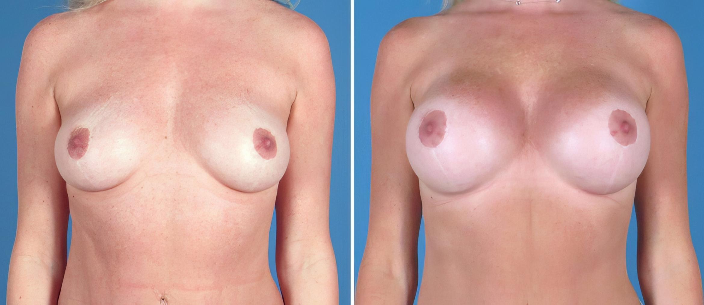 Before & After Breast Augmentation Case 26713 View #1 View in Alpharetta, GA
