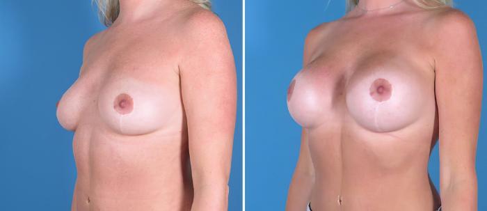 Before & After Breast Augmentation Case 26713 View #2 View in Alpharetta, GA