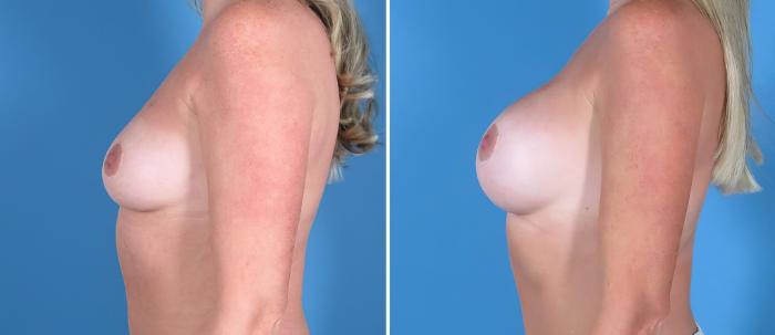 Before & After Breast Augmentation Case 26713 View #3 View in Alpharetta, GA