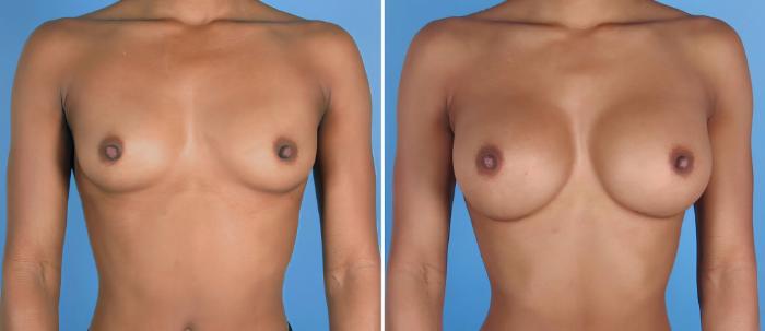 Before & After Breast Augmentation Case 26802 View #1 View in Alpharetta, GA