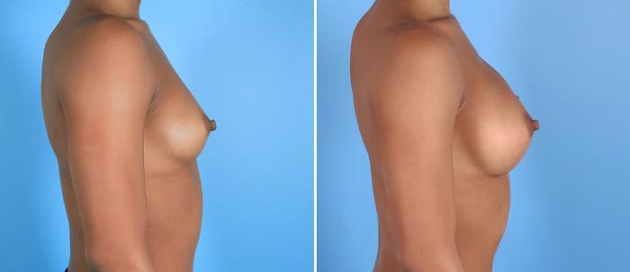 Before & After Breast Augmentation Case 26802 View #2 View in Alpharetta, GA