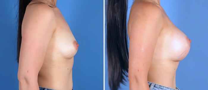 Before & After Breast Augmentation Case 26840 View #3 View in Alpharetta, GA