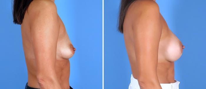 Before & After Breast Augmentation Case 26844 View #2 View in Alpharetta, GA