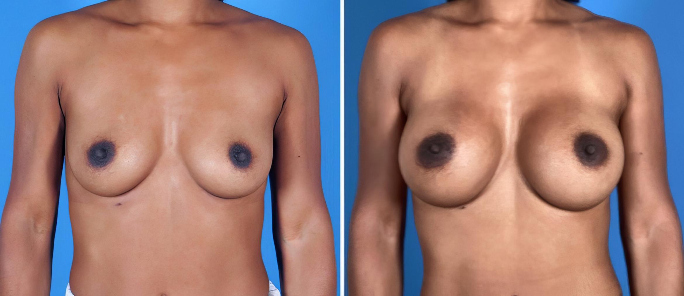 Before & After Breast Augmentation Case 27159 View #1 View in Alpharetta, GA