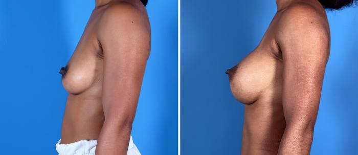 Before & After Breast Augmentation Case 27159 View #2 View in Alpharetta, GA