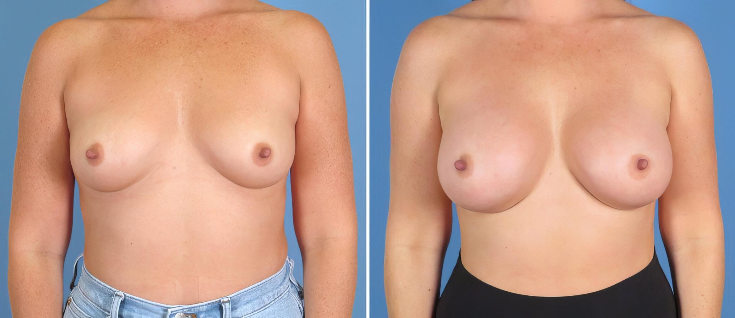 Before & After Breast Augmentation Case 27545 View #1 View in Alpharetta, GA