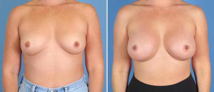 Before & After Breast Augmentation Case 27545 View #1 View in Alpharetta, GA