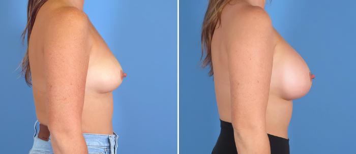 Before & After Breast Augmentation Case 27545 View #2 View in Alpharetta, GA