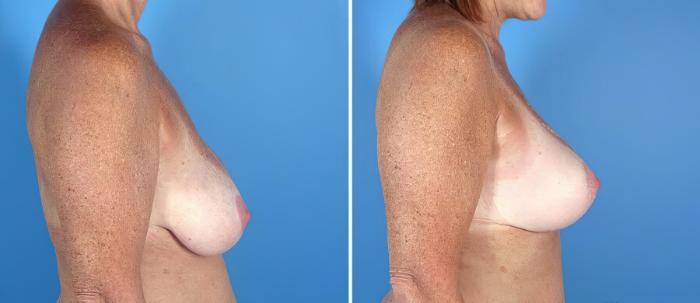 Before & After Breast Augmentation with Lift Case 17621 View #2 View in Alpharetta, GA