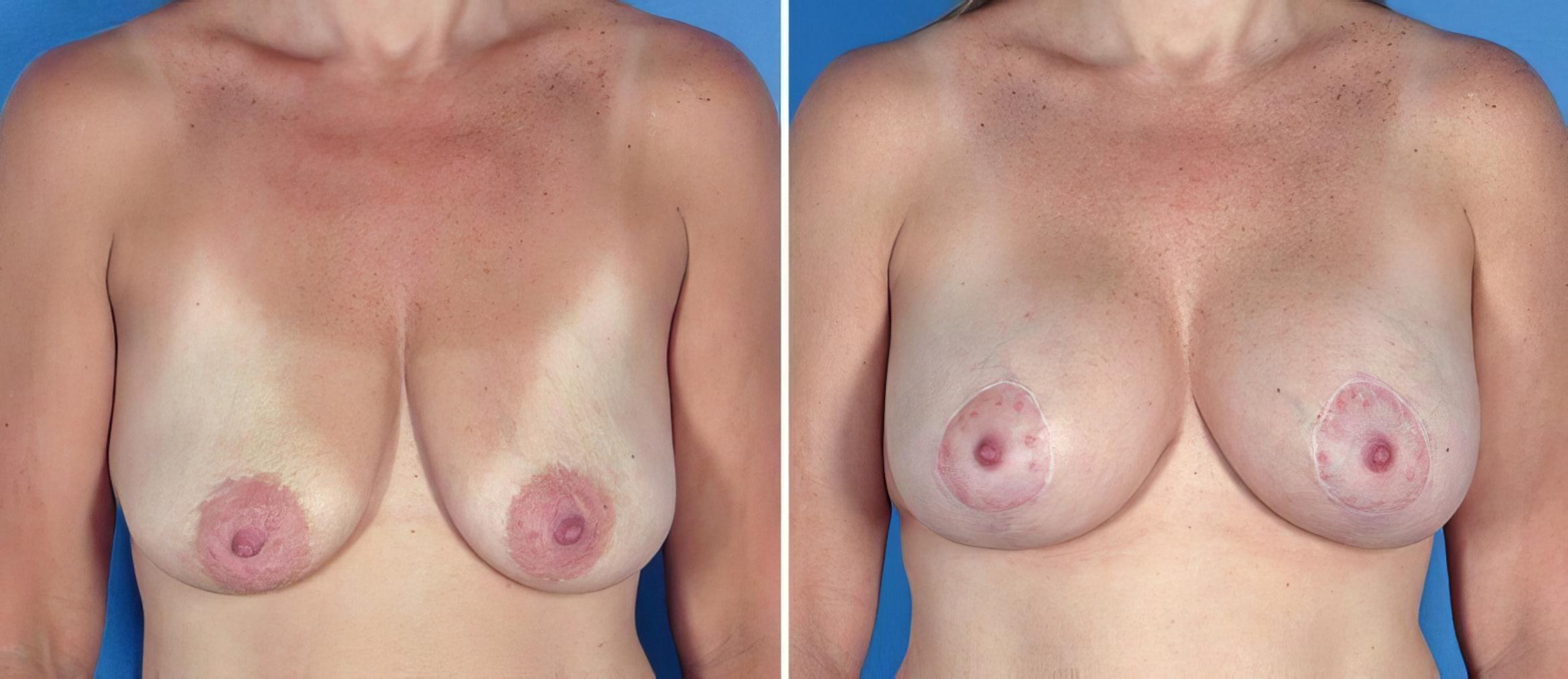 Before & After Breast Augmentation with Lift Case 17627 View #1 View in Alpharetta, GA