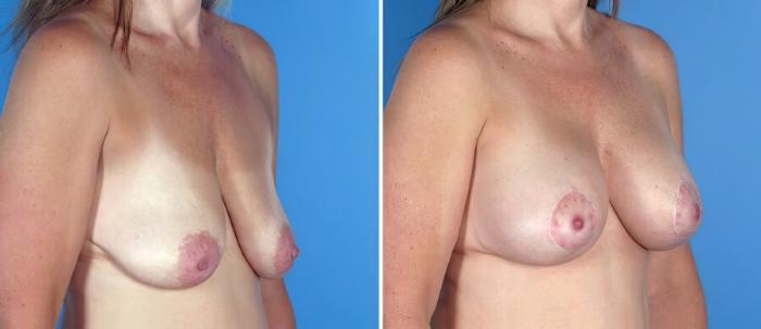 Before & After Breast Augmentation with Lift Case 17627 View #2 View in Alpharetta, GA