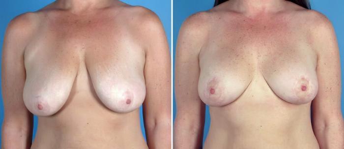 Before & After Breast Augmentation with Lift Case 17757 View #1 View in Alpharetta, GA