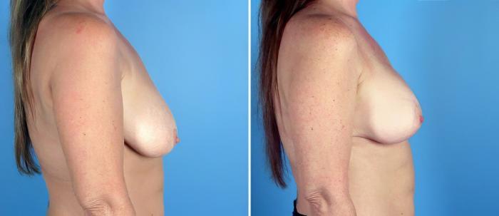 Before & After Breast Augmentation with Lift Case 17757 View #2 View in Alpharetta, GA