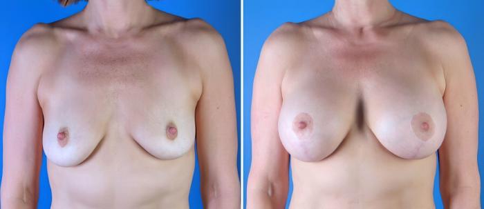 Before & After Breast Augmentation with Lift Case 17895 View #1 View in Alpharetta, GA
