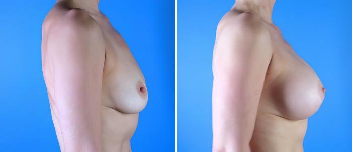 Before & After Breast Augmentation with Lift Case 17895 View #2 View in Alpharetta, GA