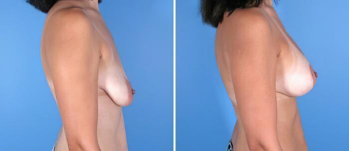 Before & After Breast Augmentation with Lift Case 17904 View #1 View in Alpharetta, GA