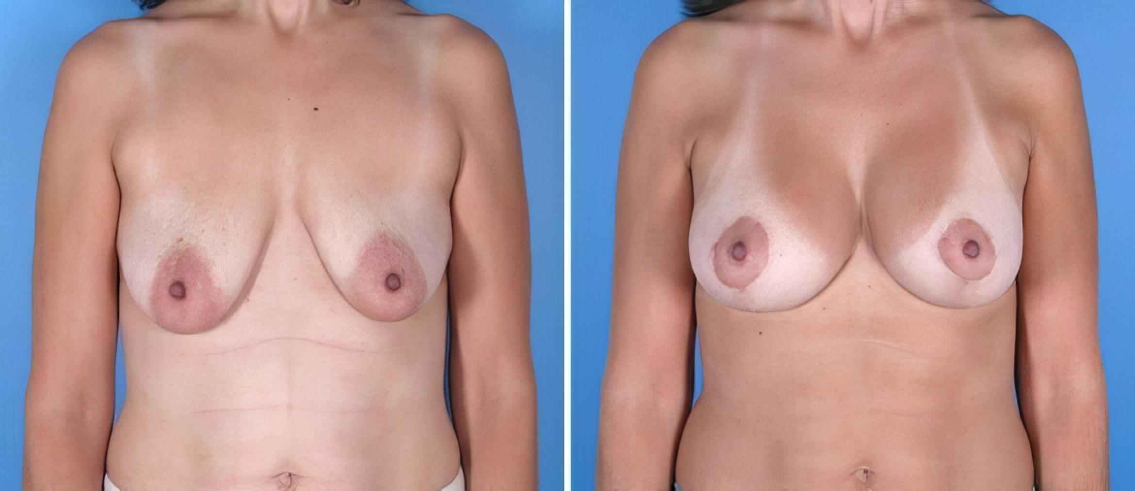 Before & After Breast Augmentation with Lift Case 17904 View #2 View in Alpharetta, GA