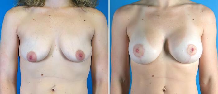 Before & After Breast Augmentation with Lift Case 17907 View #2 View in Alpharetta, GA