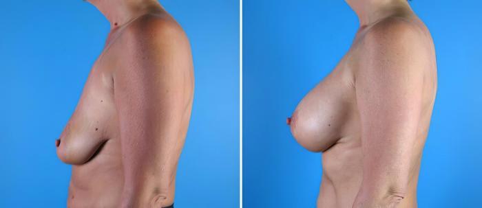 Before & After Breast Augmentation with Lift Case 17931 View #1 View in Alpharetta, GA
