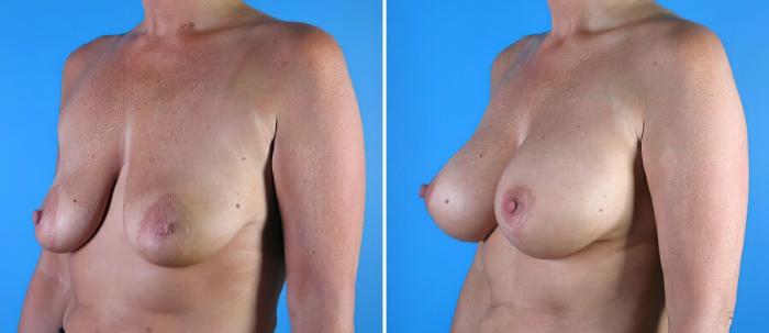 Before & After Breast Augmentation with Lift Case 17931 View #2 View in Alpharetta, GA