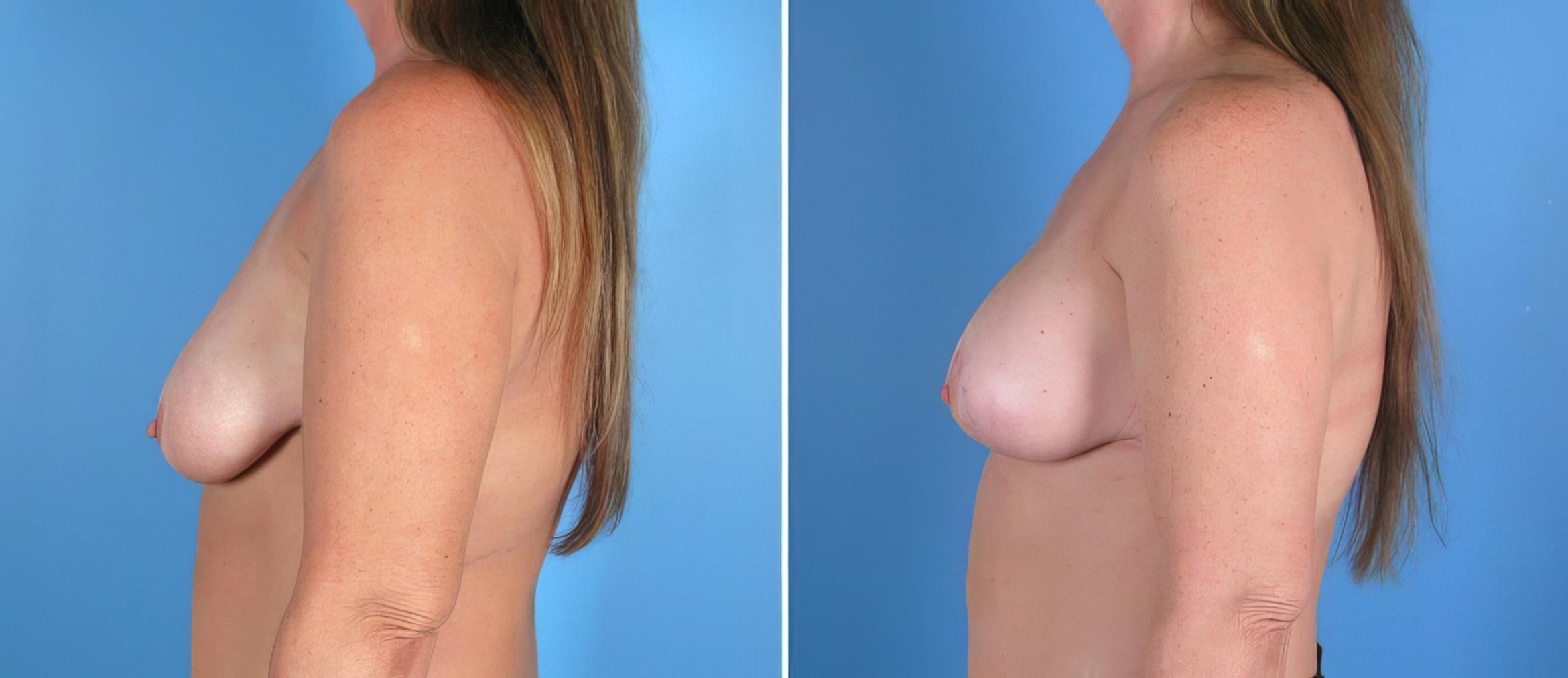 Before & After Breast Augmentation with Lift Case 17934 View #1 View in Alpharetta, GA