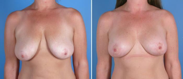 Before & After Breast Augmentation with Lift Case 17934 View #2 View in Alpharetta, GA