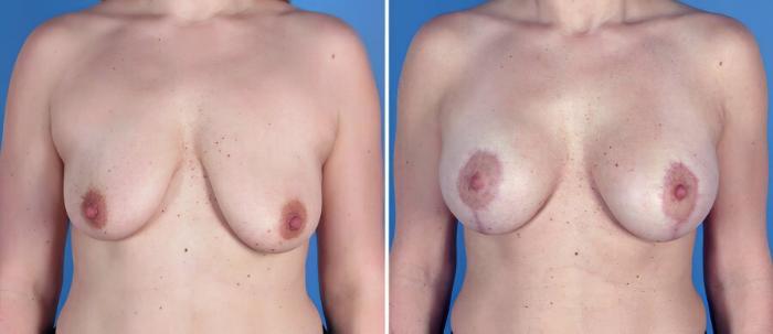 Before & After Breast Augmentation with Lift Case 18049 View #1 View in Alpharetta, GA