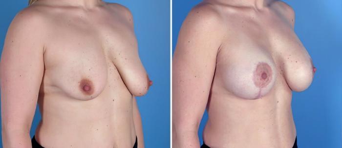 Before & After Breast Augmentation with Lift Case 18049 View #2 View in Alpharetta, GA
