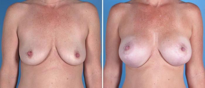 Before & After Breast Augmentation with Lift Case 18057 View #1 View in Alpharetta, GA