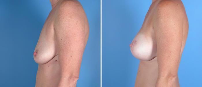 Before & After Breast Augmentation with Lift Case 18057 View #2 View in Alpharetta, GA