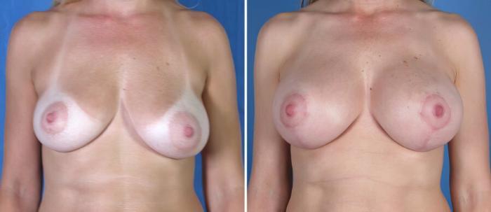 Before & After Breast Augmentation with Lift Case 18060 View #1 View in Alpharetta, GA
