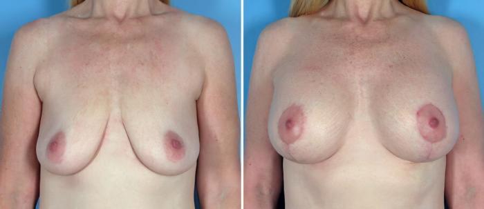 Before & After Breast Augmentation with Lift Case 18066 View #1 View in Alpharetta, GA