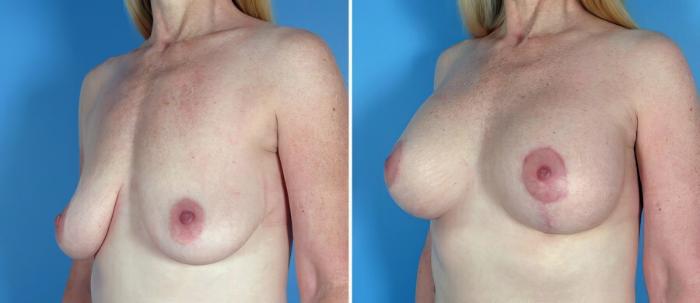 Before & After Breast Augmentation with Lift Case 18066 View #2 View in Alpharetta, GA