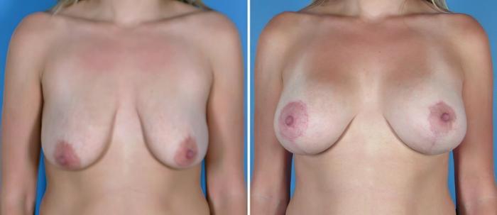 Before & After Breast Augmentation with Lift Case 18069 View #1 View in Alpharetta, GA