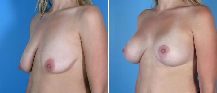 Before & After Breast Augmentation with Lift Case 18069 View #2 View in Alpharetta, GA
