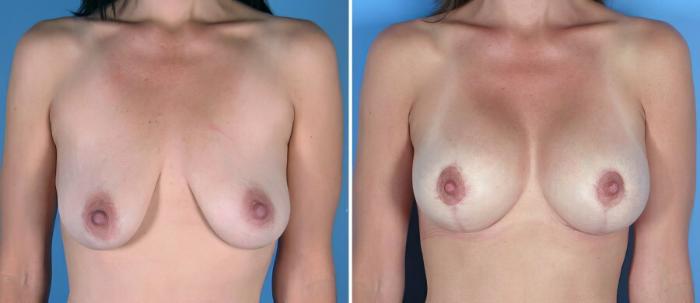 Before & After Breast Augmentation with Lift Case 18072 View #1 View in Alpharetta, GA