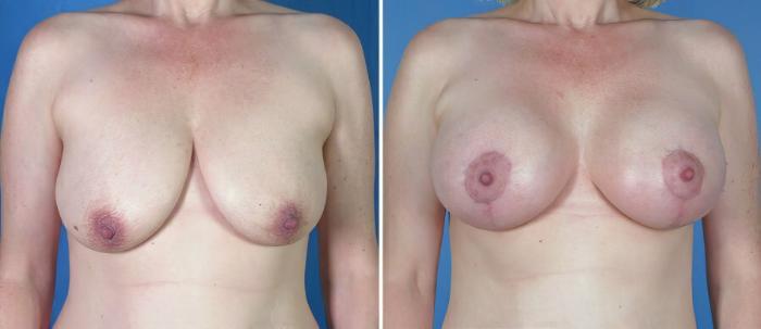 Before & After Breast Augmentation with Lift Case 18075 View #1 View in Alpharetta, GA