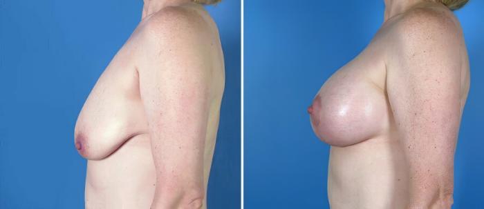 Before & After Breast Augmentation with Lift Case 18075 View #2 View in Alpharetta, GA