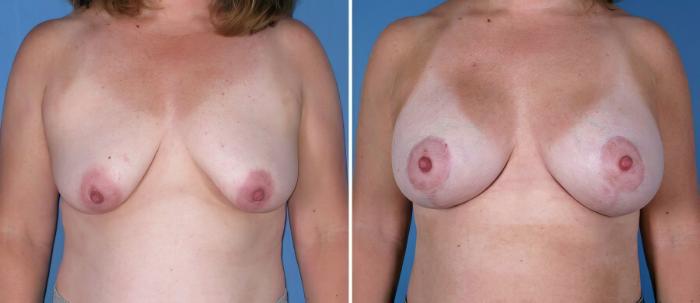 Before & After Breast Augmentation with Lift Case 18085 View #1 View in Alpharetta, GA