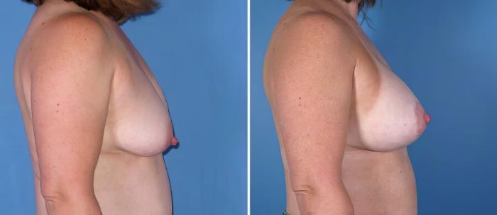 Before & After Breast Augmentation with Lift Case 18085 View #2 View in Alpharetta, GA