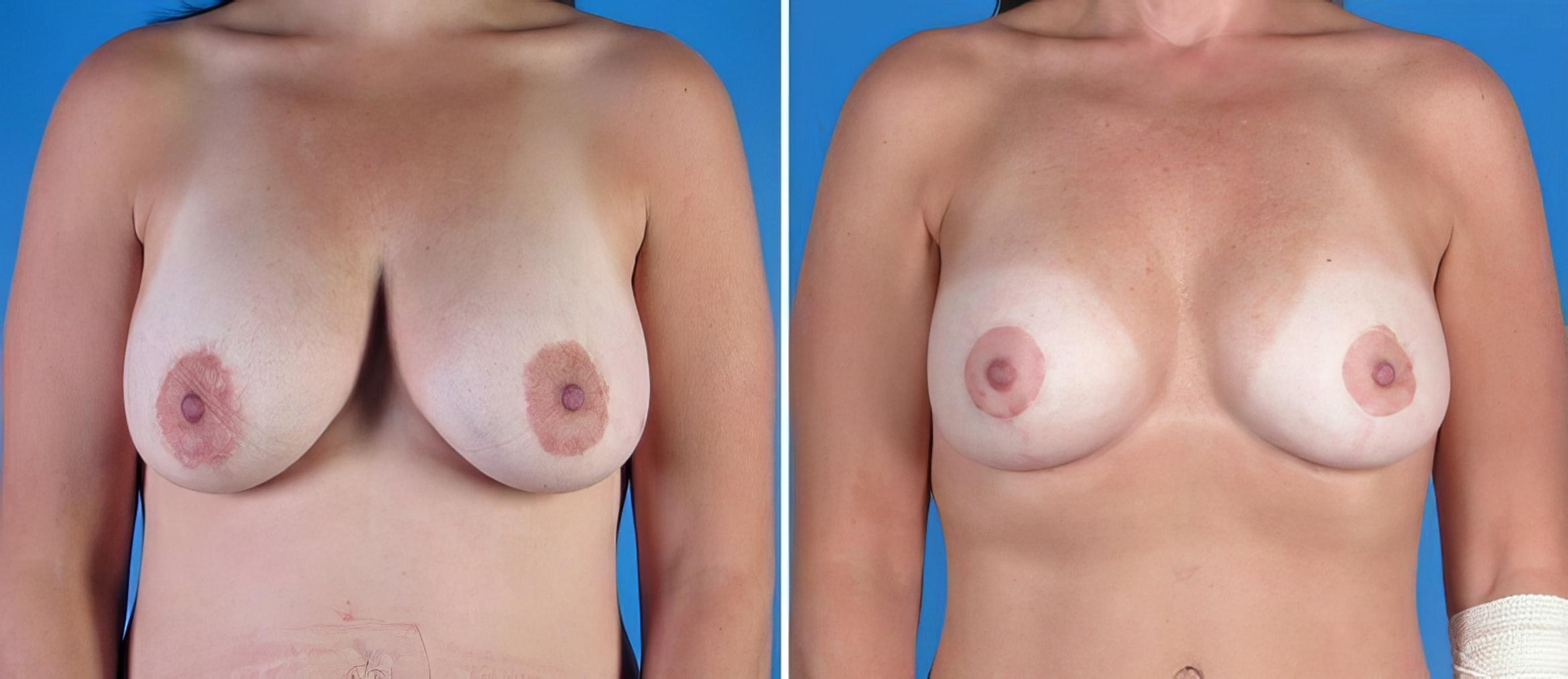 Before & After Breast Augmentation with Lift Case 18088 View #1 View in Alpharetta, GA
