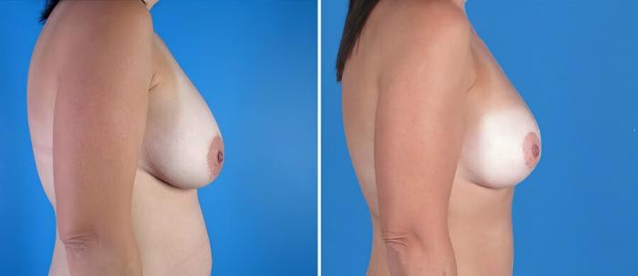 Before & After Breast Augmentation with Lift Case 18088 View #2 View in Alpharetta, GA