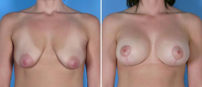 Before & After Breast Augmentation with Lift Case 18098 View #1 View in Alpharetta, GA