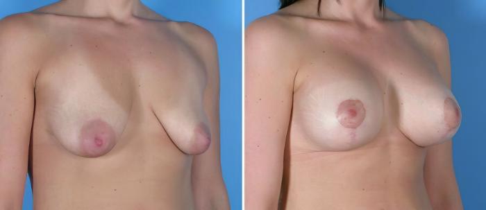 Before & After Breast Augmentation with Lift Case 18098 View #2 View in Alpharetta, GA