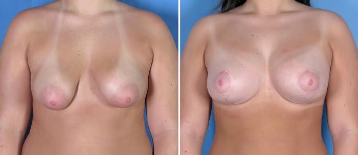 Before & After Breast Augmentation with Lift Case 18101 View #1 View in Alpharetta, GA