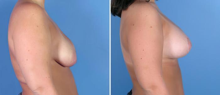 Before & After Breast Augmentation with Lift Case 18101 View #2 View in Alpharetta, GA