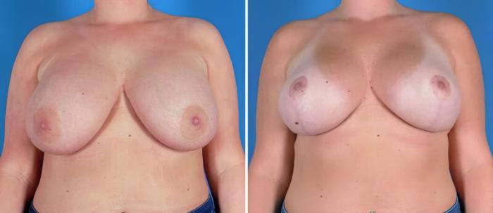 Before & After Breast Augmentation with Lift Case 22940 View #1 View in Alpharetta, GA