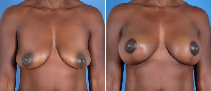 Before & After Breast Augmentation with Lift Case 25498 View #1 View in Alpharetta, GA