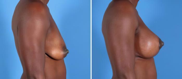 Before & After Breast Augmentation with Lift Case 25498 View #2 View in Alpharetta, GA