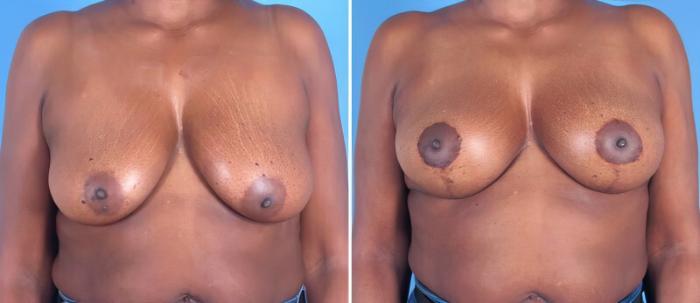 Before & After Breast Augmentation with Lift Case 25794 View #1 View in Alpharetta, GA